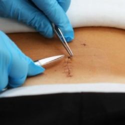 Cómo cuidar tu piel después de una cirugía; pasos clave para una recuperación sin marcas