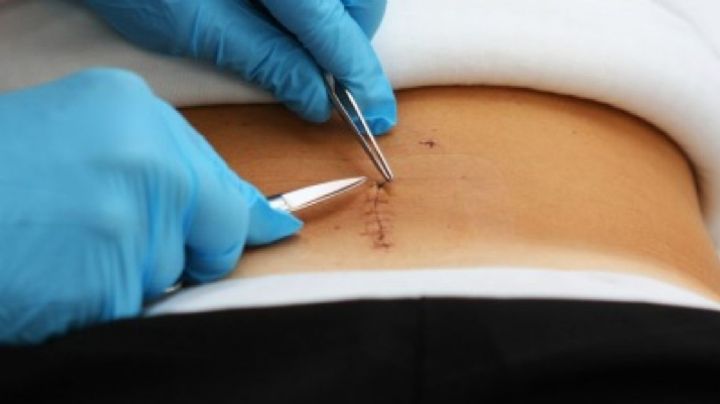 Cómo cuidar tu piel después de una cirugía; pasos clave para una recuperación sin marcas