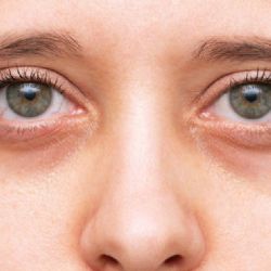 Por qué salen las ojeras y cómo evitarlas: causas reales y soluciones efectivas