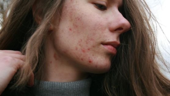 Cuatro tratamientos para eliminar las cicatrices de acné; opciones efectivas para recuperar tu piel