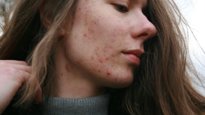 Cuatro tratamientos para eliminar las cicatrices de acné; opciones efectivas para recuperar tu piel
