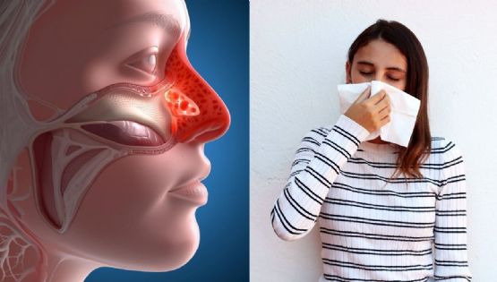 Formas naturales de reducir la congestión nasal de manera rápida y efectiva