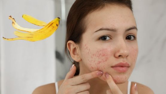 ¿Manchas y acné? Así puedes usar la cáscara de plátano para mejorar tu piel